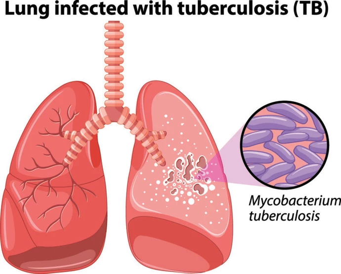 24 miljoner till forskning om tuberkulos och antibiotikaresistens