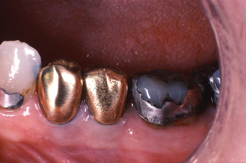 Kronisk trötthet och värk – kan det bero på implantat i tänderna?