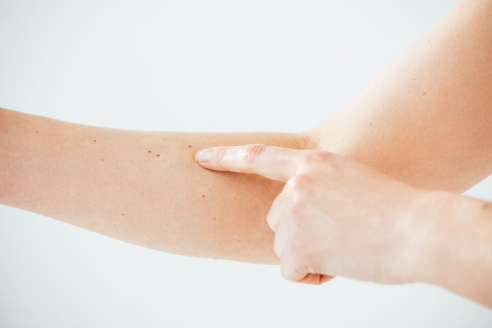 Region Dalarna ger snabbast diagnos av melanom i huden