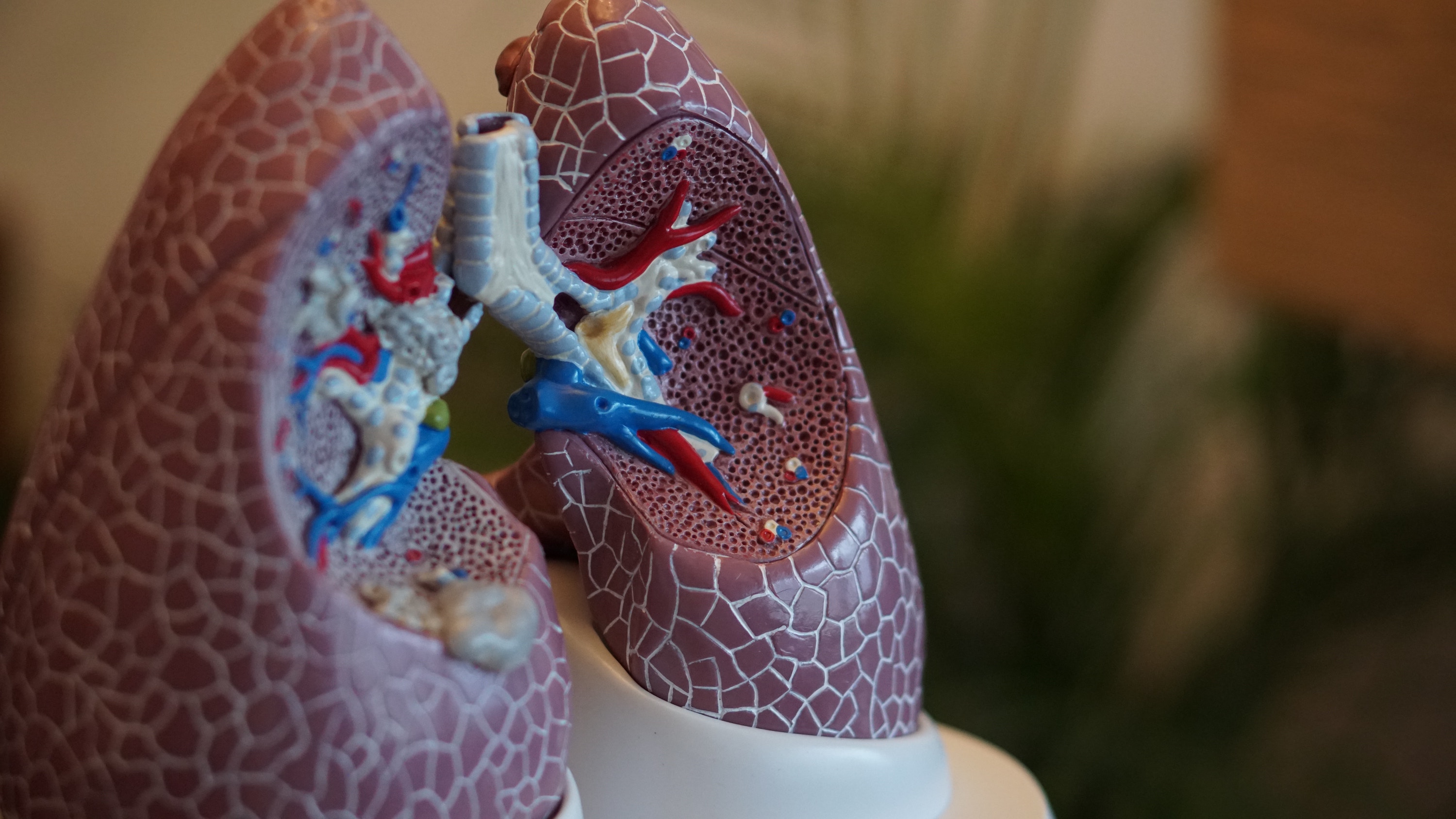 Snabba resultat för pilotstudie kring lungcancerscreening: Fler potentiella cancerfall upptäckta än förväntat