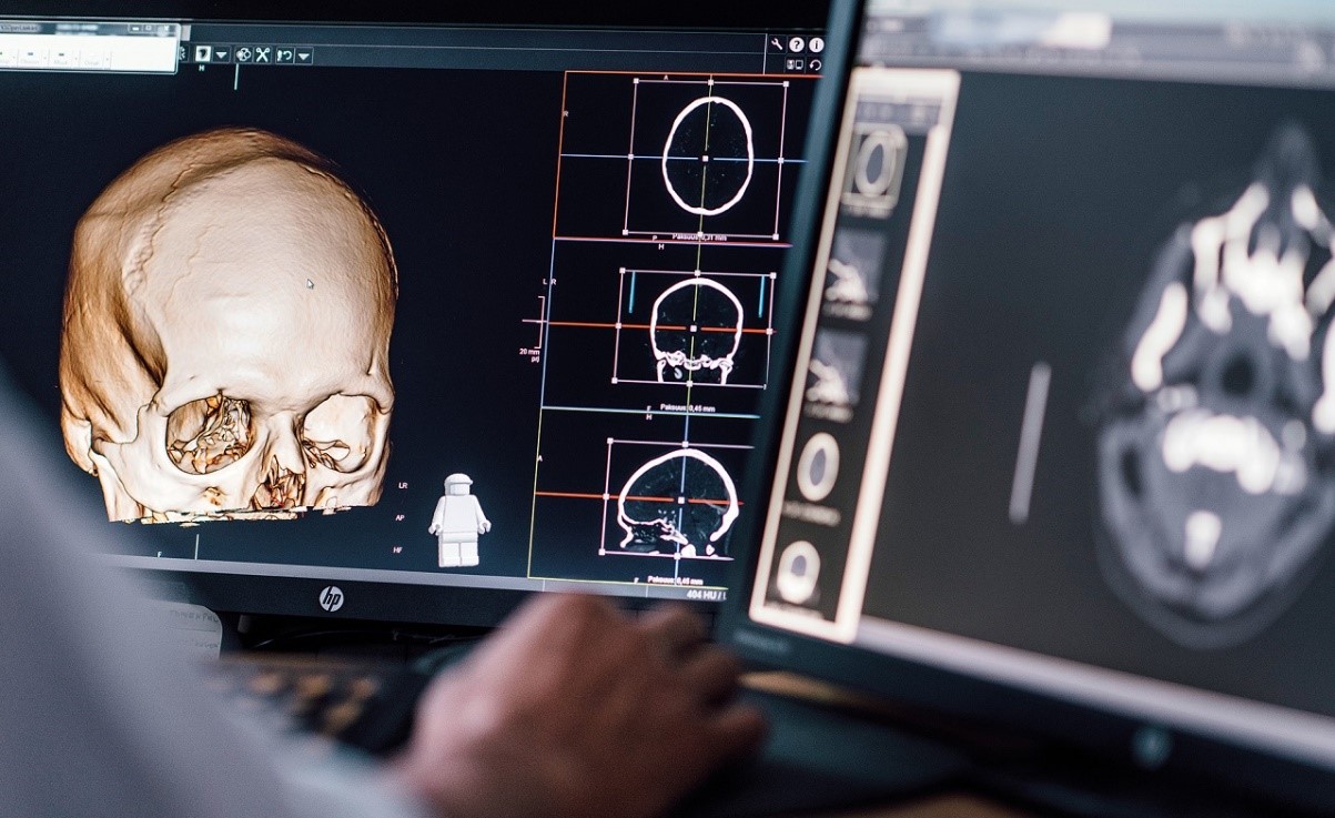 CGI i samarbete med universitetssjukhus för att utveckla AI som upptäcker hjärnblödningar