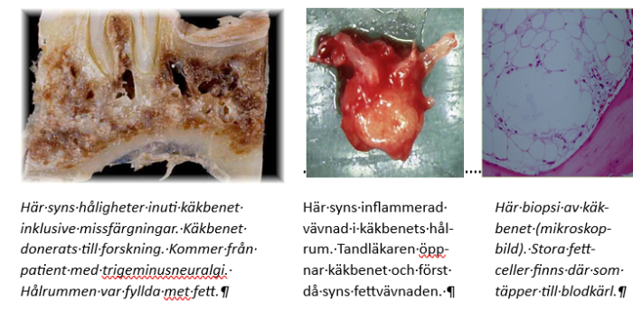 Inflammerat käkben svårt att diagnostisera