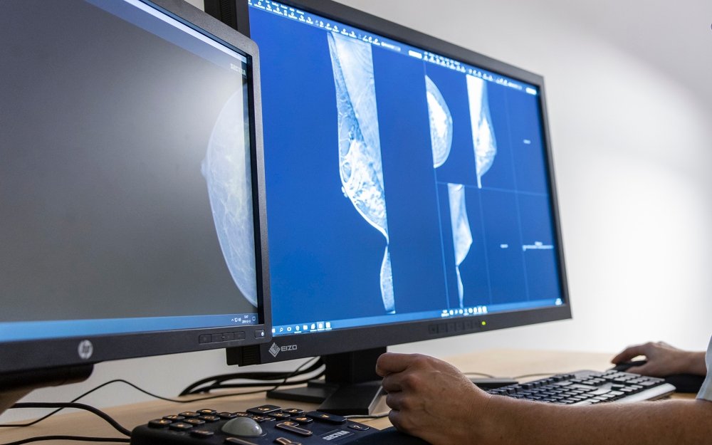 AI-stödd bröstcancerscreening: lovande resultat men många frågor ännu obesvarade