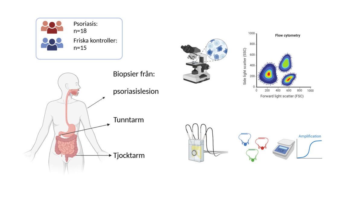 Inflammation kan förklara magbesvär vid psoriasis