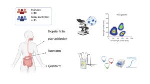 Inflammation kan förklara magbesvär vid psoriasis