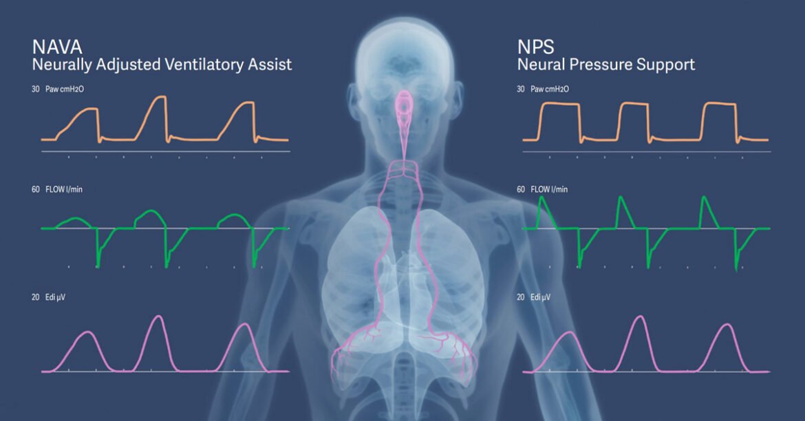 Getinge introducerar Neuralt tryckunderstöd (NPS) för Servo-u ventilatorsystem