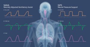 Getinge introducerar Neuralt tryckunderstöd (NPS) för Servo-u ventilatorsystem