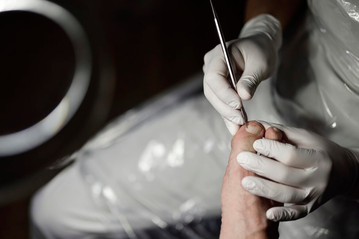 Svenskarnas fem vanligaste fotproblem – män söker hjälp onödigt sent