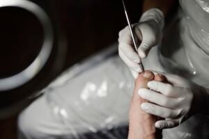 Svenskarnas fem vanligaste fotproblem – män söker hjälp onödigt sent